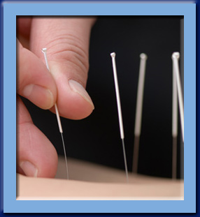 Acupuncture